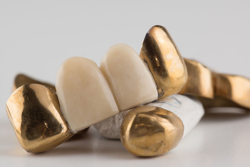Zahngold Ankauf - Verkaufen Sie Ihr Zahngold